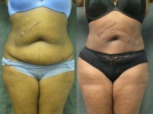 liposuction before and after