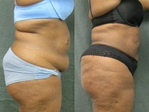 liposuction before and after side view