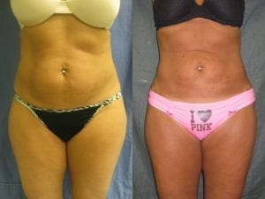 Liposuction of abdomen and flanks