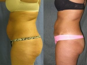 Liposuction of abdomen and flanks