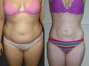 Before and after - Front View Liposuction