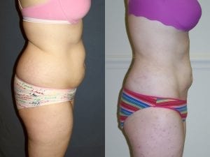 Before and after - Side View Liposuction
