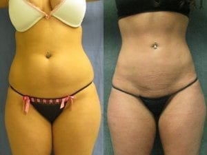 Before and after - Liposuction front view 