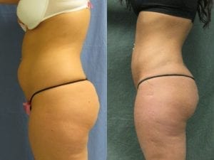 Before and after - Liposuction side view 