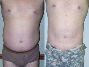 male liposuction - before and after - forward facing