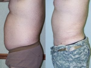 male liposuction - before and after - side facing