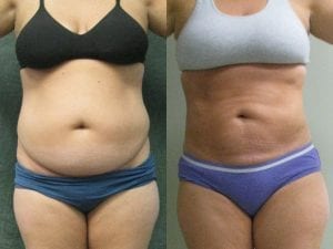 Liposuction Before and After - forward facing view