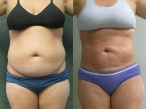 liposuction abdomen and flanks. Forward facing images Before and After