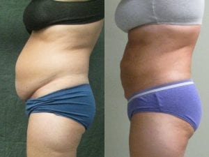 Liposuction Before and After - side facing view