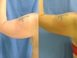 tatoo in an arm