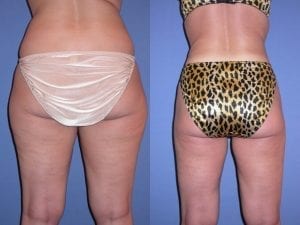Liposuction before and after - back side view
