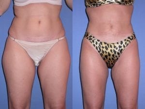 Liposuction before and after - front facing view