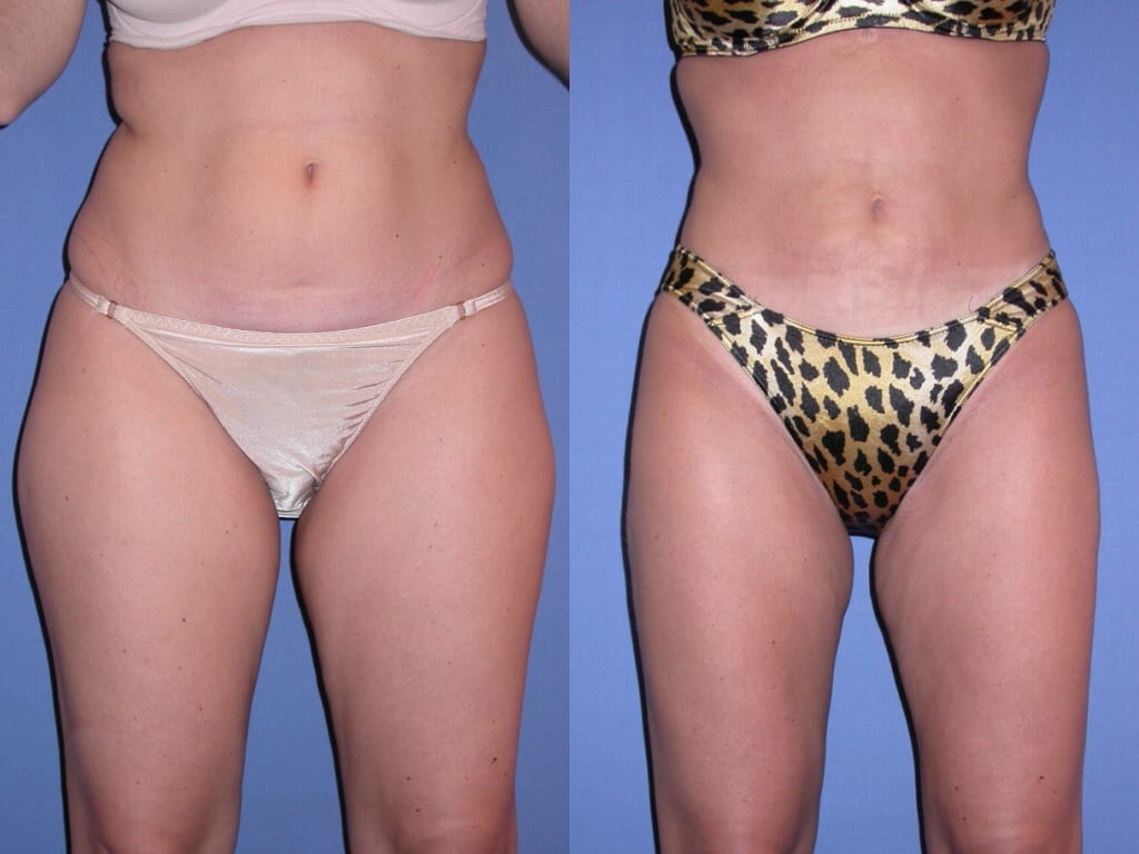 Liposuction of the 'love handles' or flanks