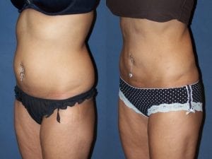 Before and after Liposuction side facing view
