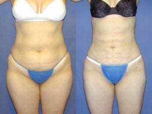 Liposuction before and after - front facing