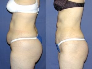 Liposuction before and after - side facing