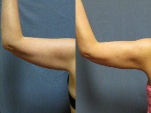 Arm lift before and after - back side of left arm