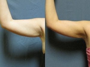Arm lift before and after - Front side of left arm