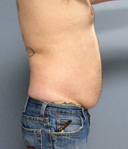 31 year old male for liposuction of the abdomen 