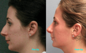 rhinoplasty side view