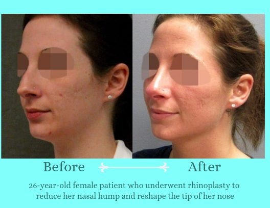 rhinoplasty-before-after-patient-2a-921-blog-ba-img