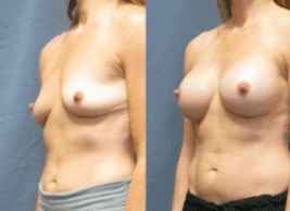 Dr. Matt Goldschmidt Breast Augmentation patient with Implants