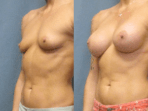 Dr Matt Goldschmidt Gel Breast Implant patient