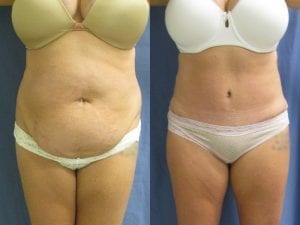 Abdominoplasty Patient 01 before and after facing forward.