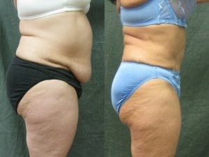 Abdominoplasty Patient 04 before and after facing right.