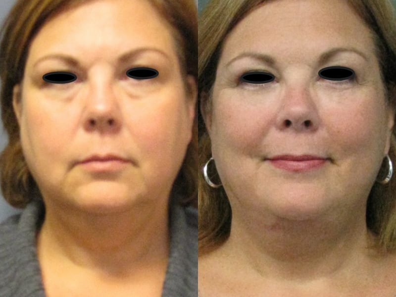 Blepharoplasty Patient 01 before and after facing forward. blepharoplasty-before-after-patient-1a