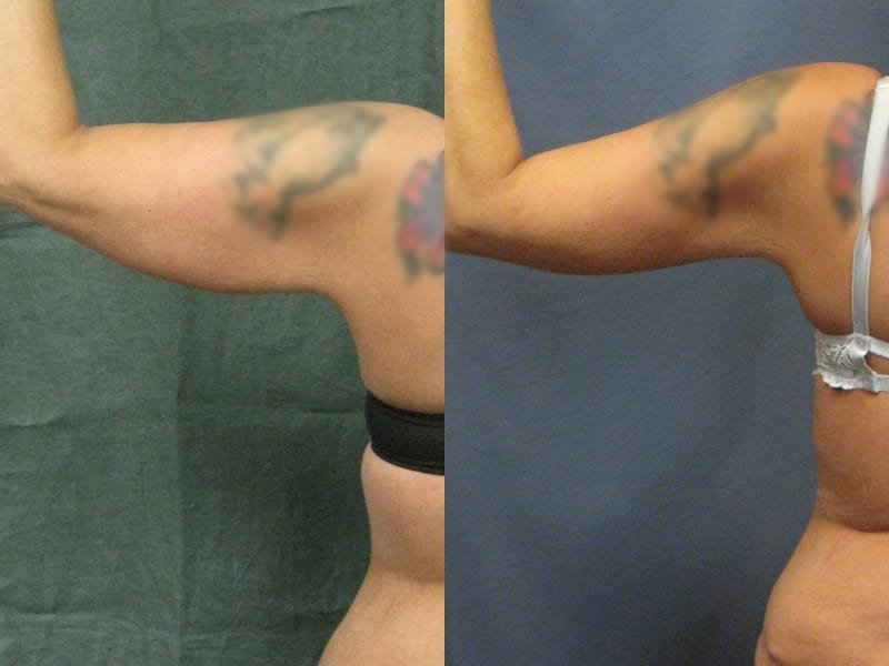 Brachioplasty Patient 02 before and after left arm raised. brachioplasty-before-after-patient-2a