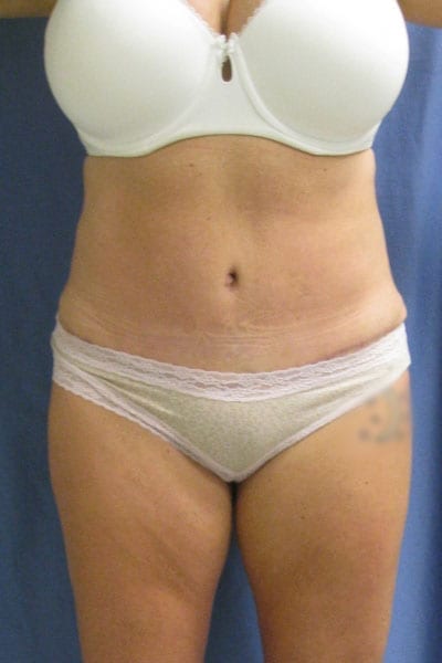 Tummy Tuck after