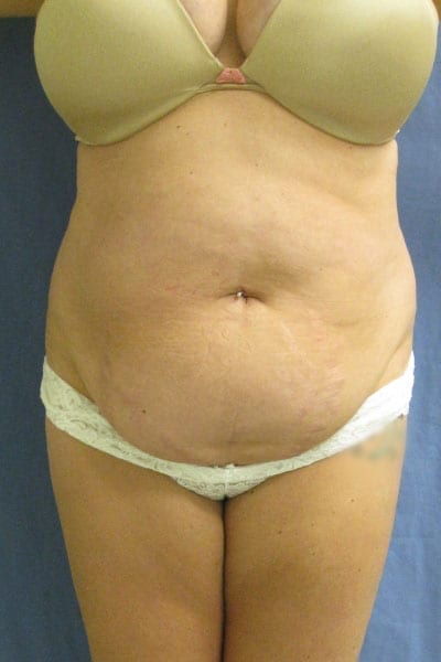 Tummy Tuck before