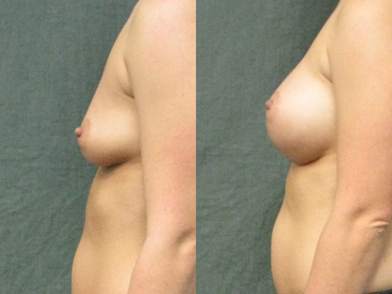 breast-aug-gel-before-after-patient-1c-img-blog