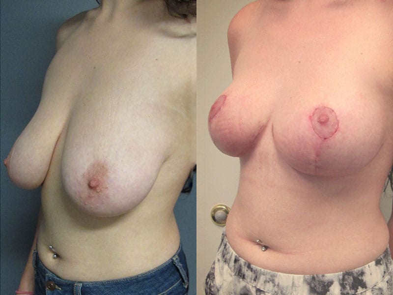 before and after breast lift