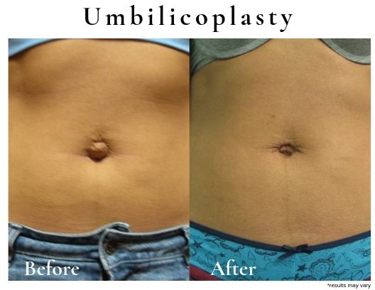 umbilicoplasty-before-after-patient-2a-blog-ba-image
