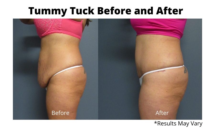 Before and after image showing the results of a tummy tuck by Dr. Matt Goldschmidt