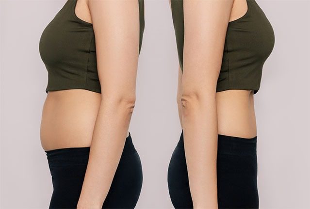 Mini Tummy Tuck NYC  Tone Your Midsection Elegantly