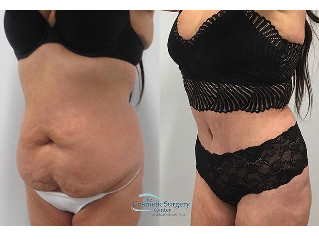 Before and after image of a Tummy Tuck patent