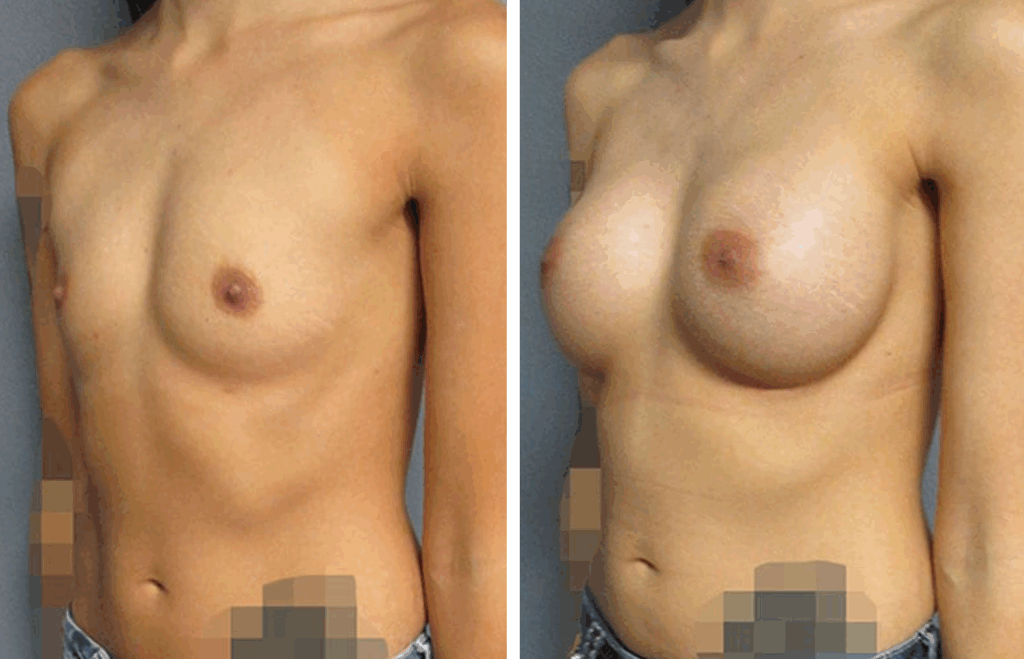 Actual patient before and after results