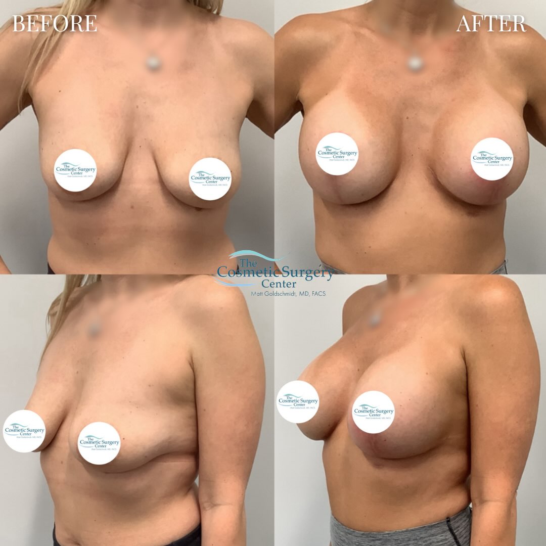BREAST LIFT WITH IMPLANTS This patient is feeling rejuvenated after her breast lift with augmentation procedure! We used 450cc cohesive gel implants for a round, perky bust. She’s definitely making sure to enjoy these last weeks of summer Call 216-264-8100 to schedule your consultation and transform your look! #breastaugmentation #breastlift #cosmeticsurgery #cosmeticsurgeon #cleveland