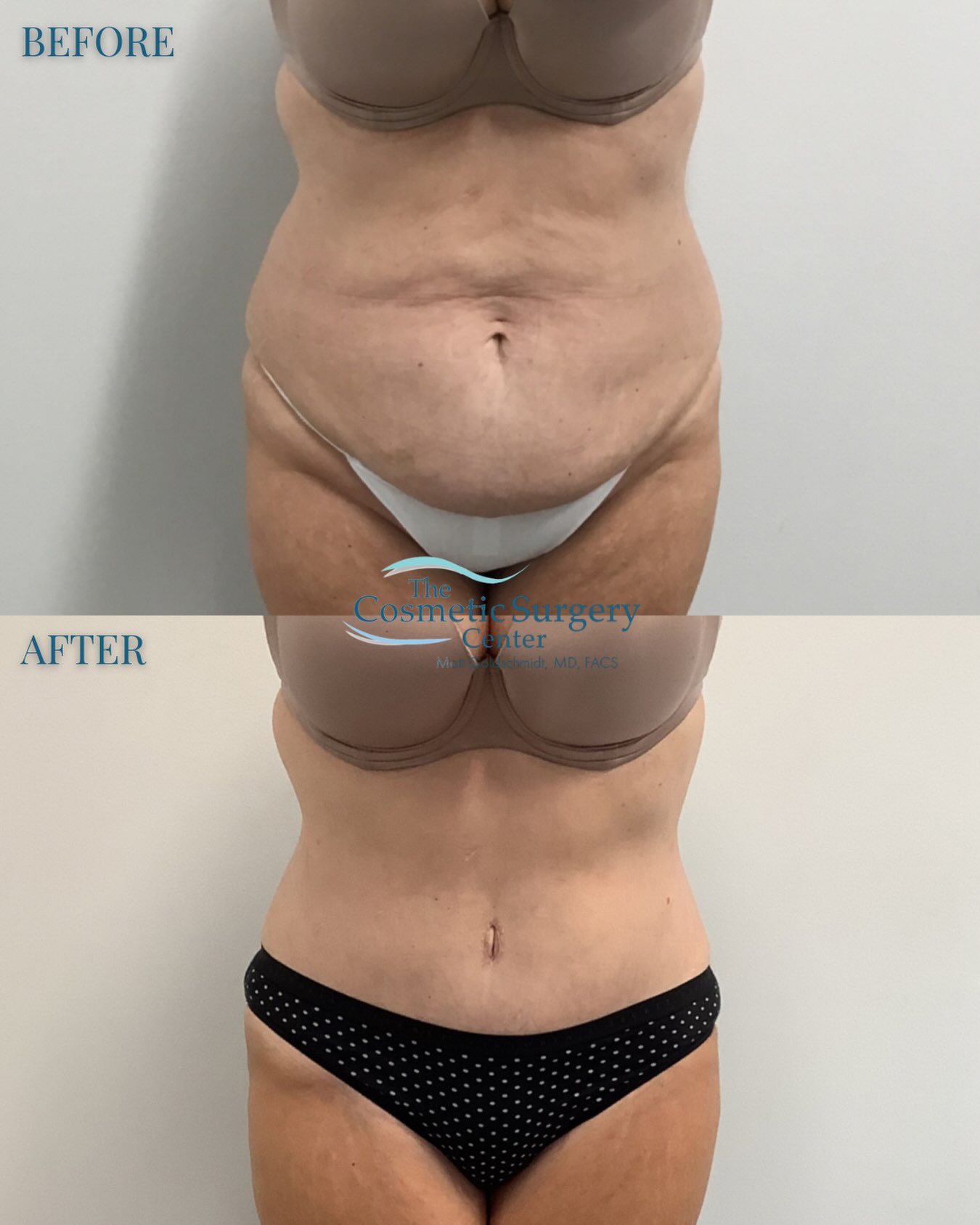 TUMMY TUCK It’s Fri-YAY! This patient is ready for the weekend rocking her flat, tightened stomach!