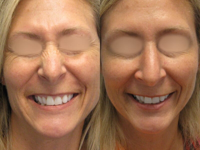 Before & After Botox Photos | Dr. Matt Goldschmidt | Independence, OH before-after-botox-dr-matt-goldschmidt-independence-oh