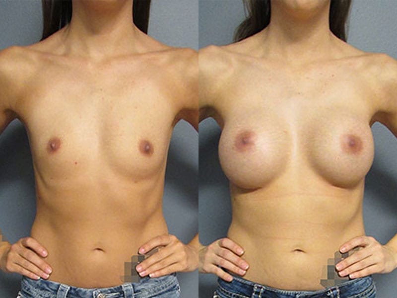 Before & After Breast Augmentation Photos | Dr. Matt Goldschmidt | Independence, OH before-after-breast-augmentation-dr-matt-goldschmidt-independence-oh