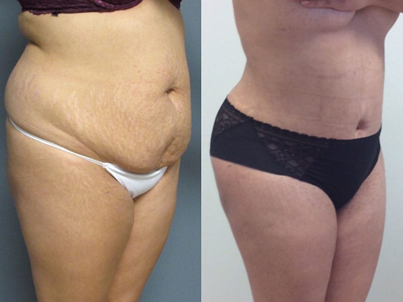 Dr. Matt Goldschmidt: Abdominoplasty Before & After Photos