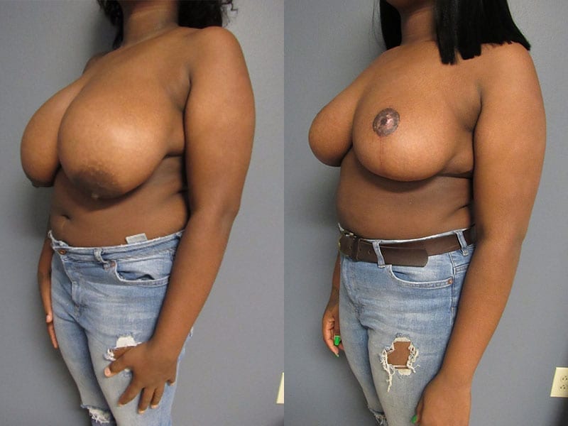 Breast Reduction Patient 01.