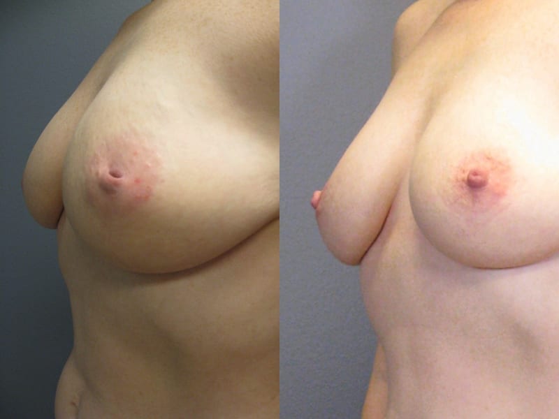 Inverted Nipple Correction Patient 02 before and after angled left. breast-nipple-correction-before-after-patient-2a
