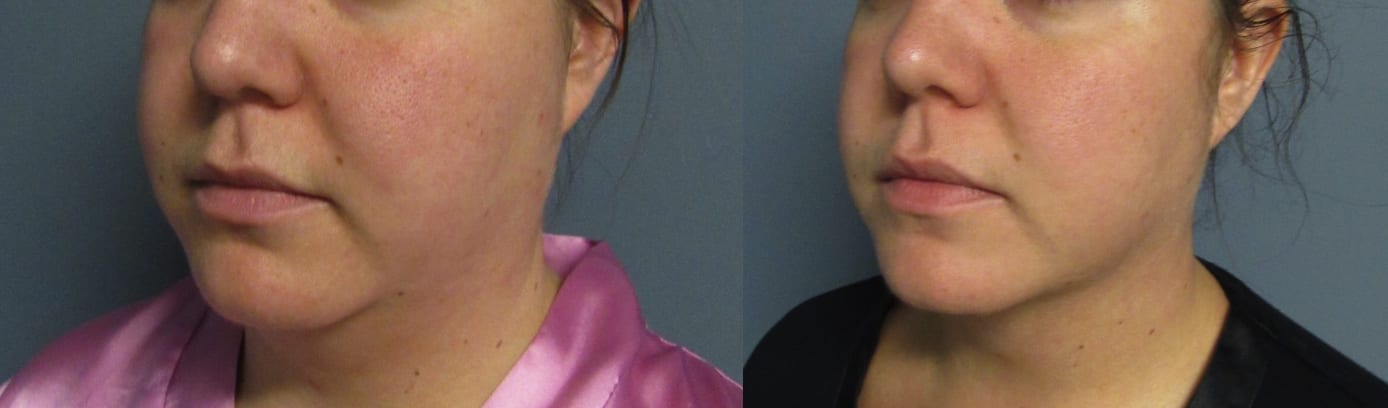 Before and After Image