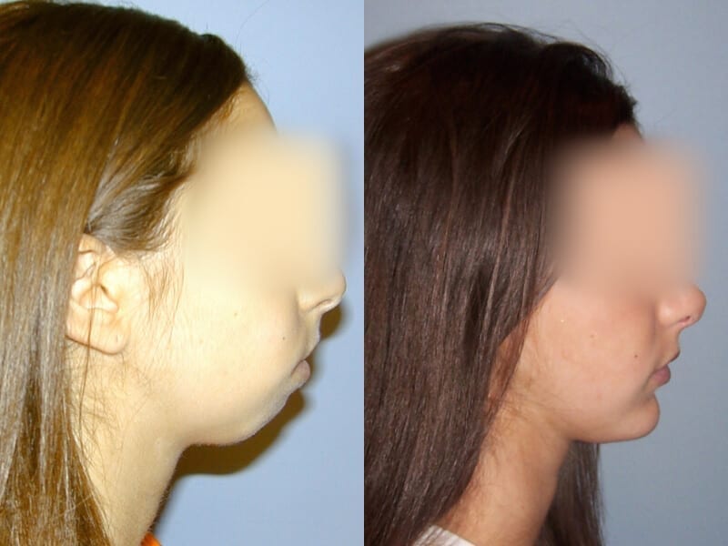 Before & After Facial Implants Photos | Dr. Matt Goldschmidt | Independence, OH before-after-facial-implants-dr-matt-goldschmidt-independence-oh