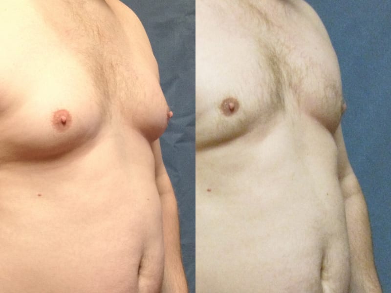 Gynecomastia Patient 03 before and after angled right. gynecomastia-before-after-patient-3a